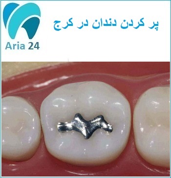 مطب خوب برای پر کردن دندان در کرج |مشاوره رایگان دکتر سید محسنی : 02632770097 - 09001222030
